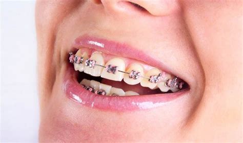 Biaya spesialis ortodonti  Perbedaan bahan pembuat aligner dan behel